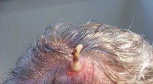 Симптомами проникновения насекомых под кожу является возникновение язв, фурункулов с сильным зудом