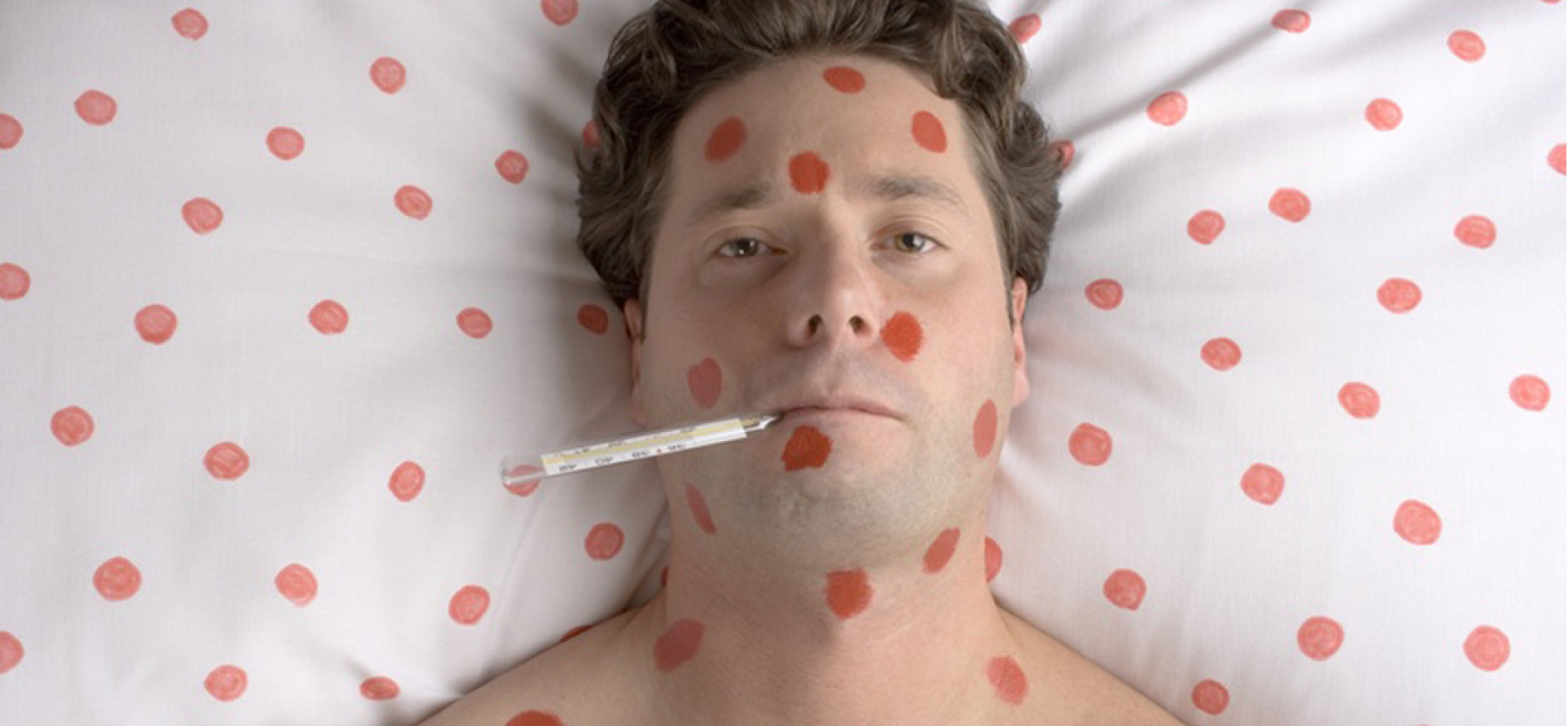 Корь - симптомы у взрослых, диагностика и лечение