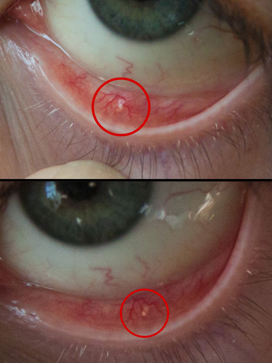 Токсокароз у взрослых: симптомы и лечение