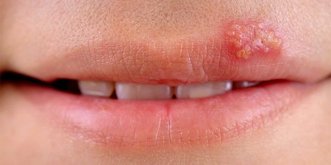 Герпес на губах имеет название «губная лихорадка», «герпес» или «простуда» и вызывают его вирусы простого герпеса первого типа