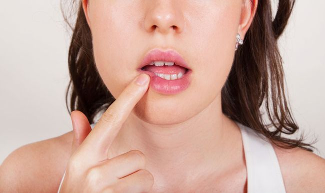 Для быстрого лечения герпеса на губах старайтесь не трогать ранку или делать это крайне редко!