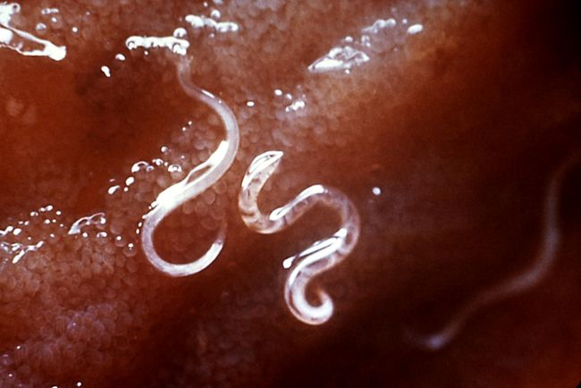 Анкилостомоз - питающийся кровью паразит длиной 2 мм