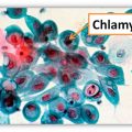Chlamydia in women: the reasons, diagnostics, treatment