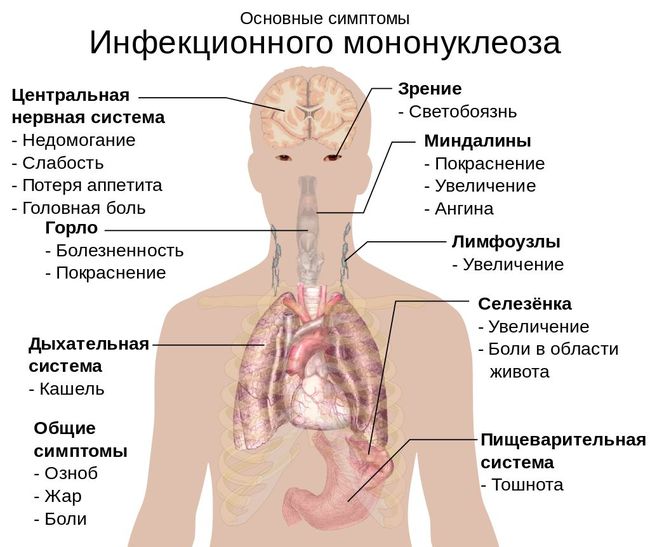 Инфекционный мононуклеоз у детей – явление нередкое, возбудителем является герпес четвертого типа