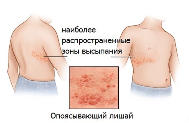 Если болезнь настигла человека в молодом возрасте, то чаще всего никаких последствий или осложнений для него она не принесет