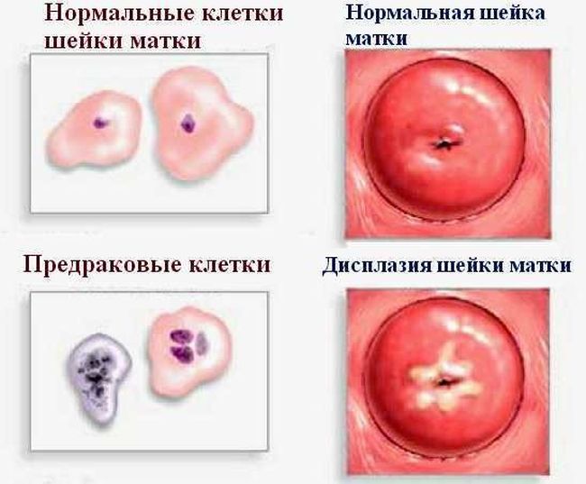 При подозрении на ВПЧ женщине необходимо обратиться в гинекологию, врач сможет быстро диагностировать заболевание