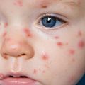 Chickenpox in children – how dangerous disease? Symptoms and Treatment