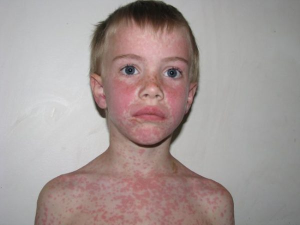 epstein-barr-virus-in-children-symptoms-and-treatment