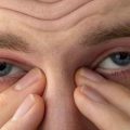 Рятуємо очі від блефарити – тривожні симптоми і лікування захворювання