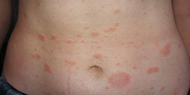 Розовый лишай у человека представляет собой инфекционно-аллергическое заболевание