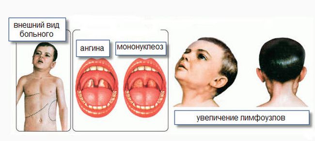 Мононуклеоз - это острое заболевание вирусного генеза, которое по симптомам напоминает обычную ангину