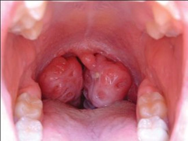 Мононуклеоз сопровождается сильной болью в горле, которая превращает прием пищи и даже глотание слюны в мучение