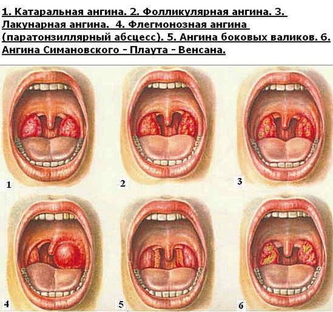 Существуют различные виды ангины: катаральная, фолликулярная, лакунарная, флегмонозная, боковых валиков, Самановского - Плаута - Венсана