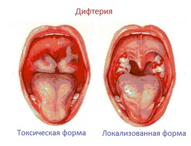 Вид токсической и локализованной формы дифтерии