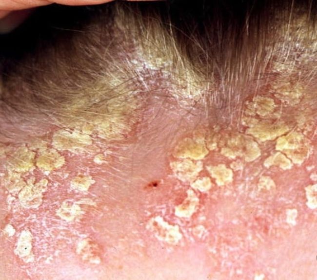 Себорейный дерматит возникает, когда на коже в зонах поражения начинает возрастать концентрация грибка