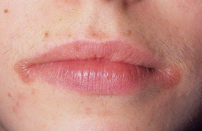 Заеды в уголках рта, или ангулит (ангулярный стоматит, хейлит ангулярный) – это трещинки, которые образовываются в углах рта, при этом они покрываются корочками, припухают и весьма болезненны
