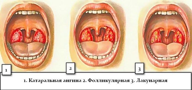 Разновидности ангин - катаральная, фолликулярная и лакунарная