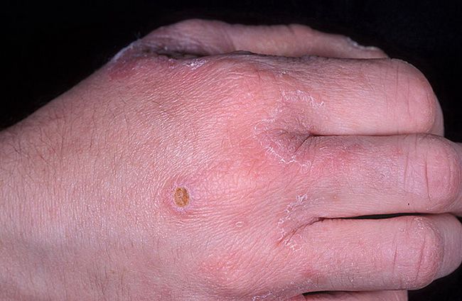 Грибок кожи рук возникает гораздо реже, чем грибок ступней.