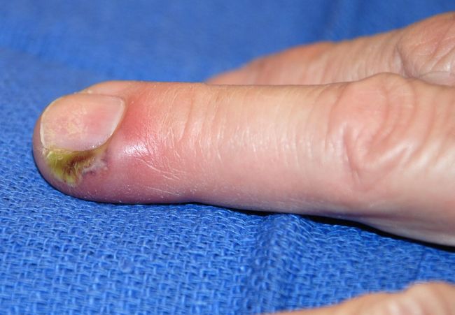 На фото показан микоз, который перешел на ногти.