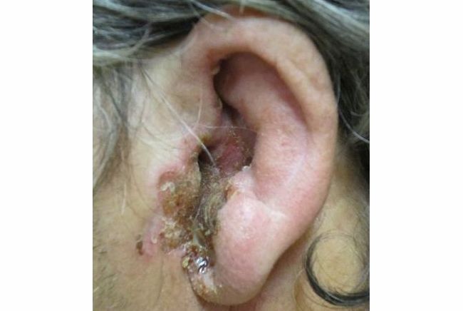 На фото показан отомикоз в ушах у человека