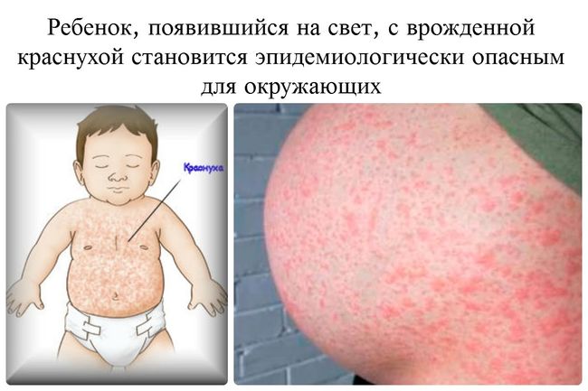 Краснуха при беременности крайне опасна для жизни ребенка