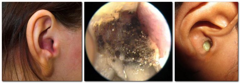 The Fungus In The Ear otomycosis A Photo Symptoms Treatment 