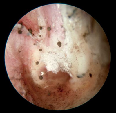 Плесневый грибок в ушах - отомикоз, фото пример.