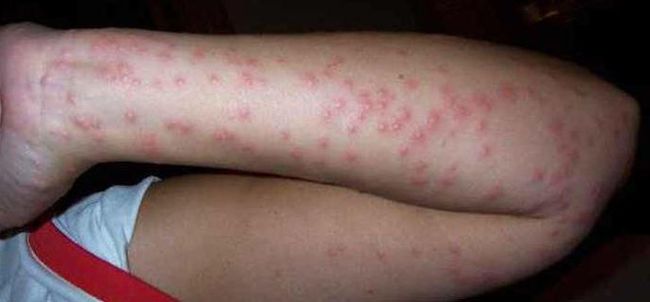 После укусов клопов на теле человека может появиться аллергия