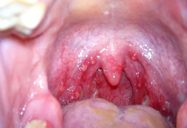 Золотистый стафилококк в горле - самый опасный представитель семейства стафилококков