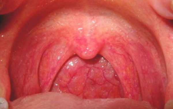 fever Sore in adults throat