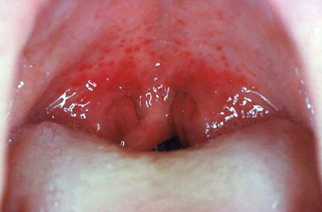 Герпетический тип ангины - характеризуется образованием везикул в области задней стенки глотки и/или нёба